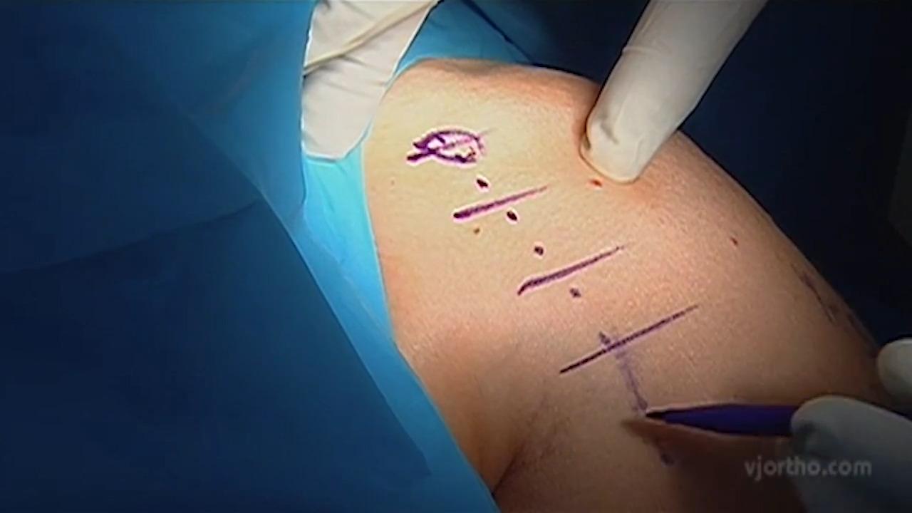 DELTA XTEND™ Reverse Shoulder System Johnson & Johnson Institute